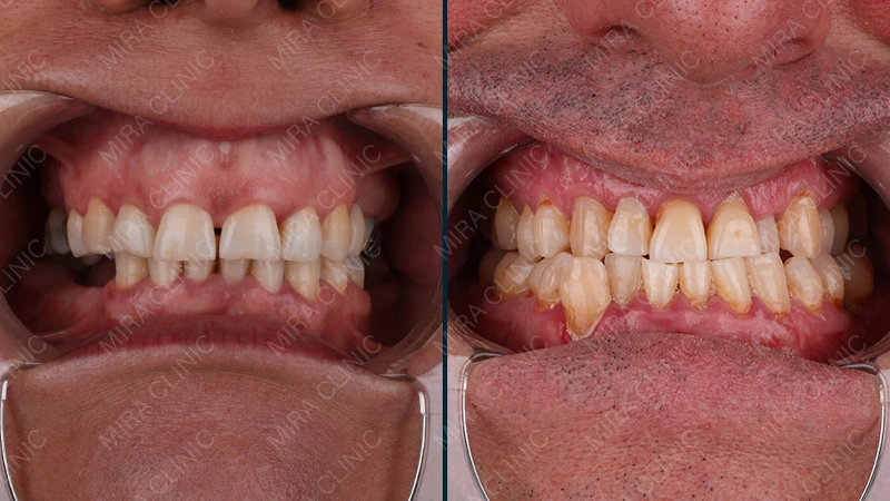 Dental Problems Before the Hollywood Smile Treatment